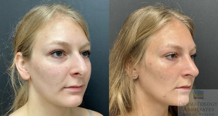 Before & After Rhinoplasty Case 92 Right Side View in Rochester, NY