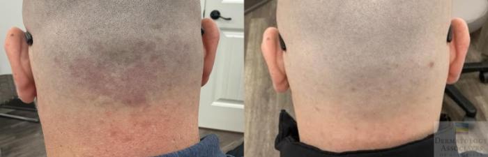 Before & After VBEAM Case 116 Back View in Rochester, NY